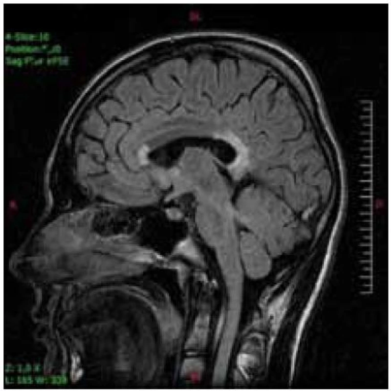Ten istý pacient s postihnutím genu a splenium corpus callosum v T2V sagitálnej projekcii.