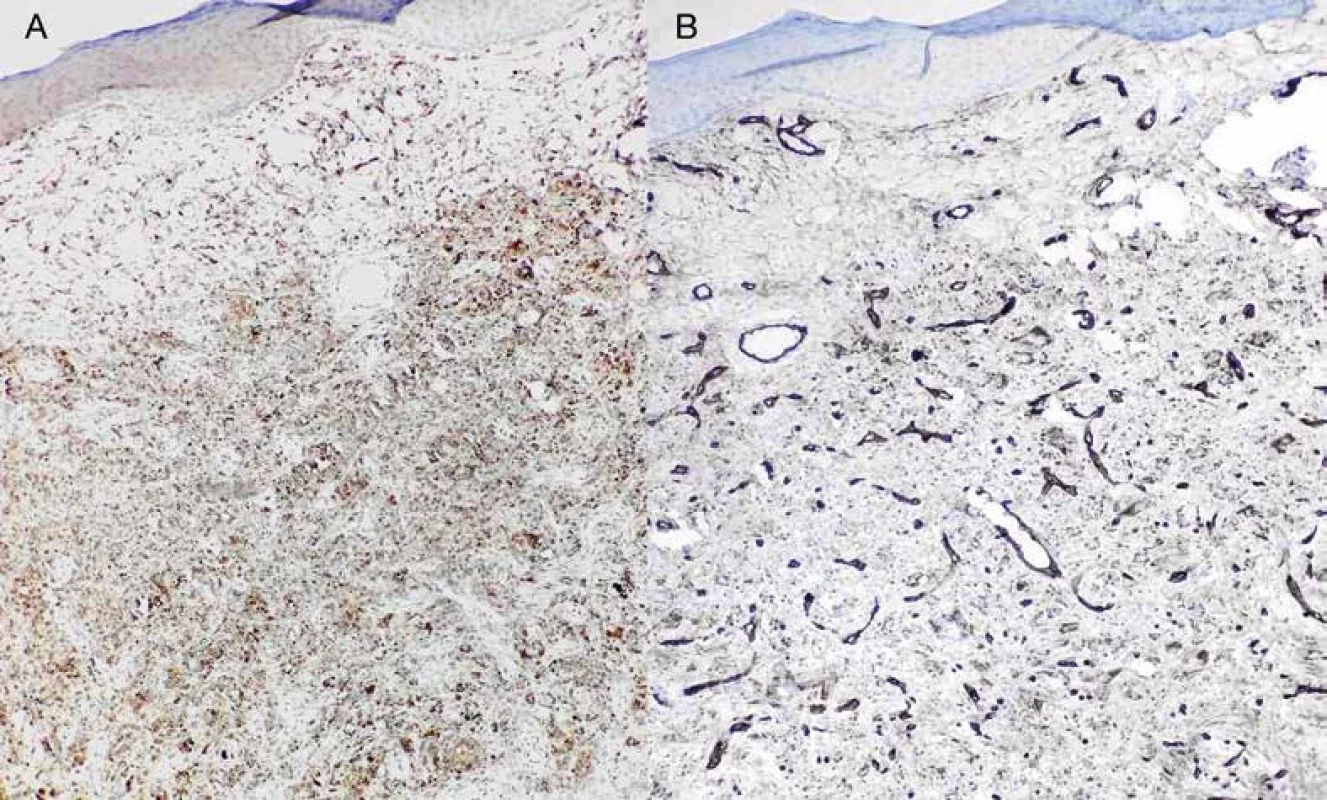 Imunohistochemický dôkaz faktora XIIIa – nádor vykazuje difúznu pozitivitu (A) a imunohistochemický dôkaz CD34 Nádor je negatívny, pričom zafarbené sú len endotelové bunky ciev (B) (25x).