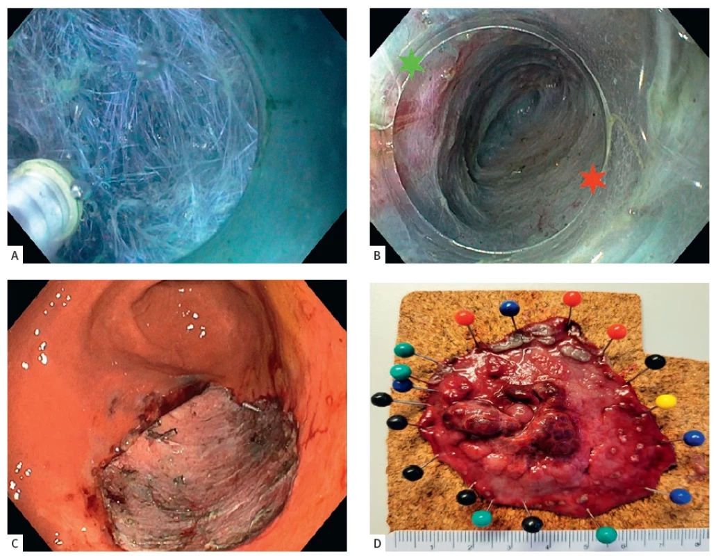 Endoskopická submukózní disekce (ESD) povrchové neoplastické léze žaludku.<br> Endoscopic submucosal dissection (ESD) of a superficial neoplastic lesion of the stomach.