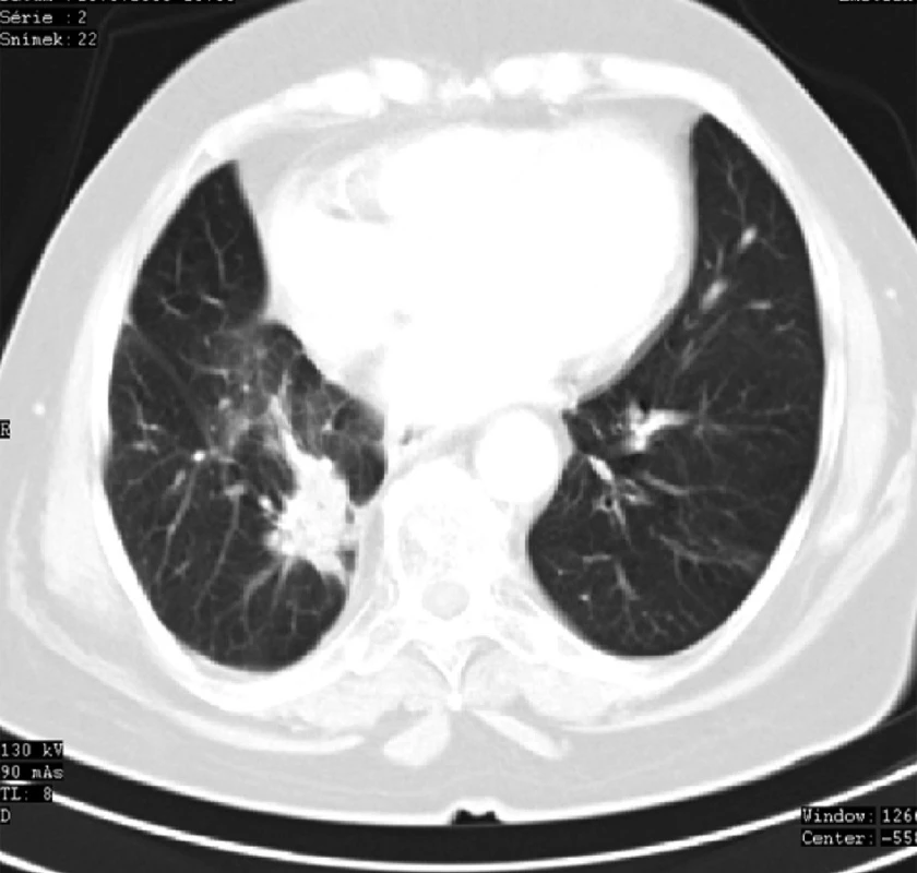 CT plic 6 měsíců po radioterapii se známkami postiradiační fibrózy v místě recidivy ložiska karcinomu
Fig. 6: Lung CT 6 months after radiotherapy with signs of post-irradiation fibrosis at the site of the tumour focus recurrence
