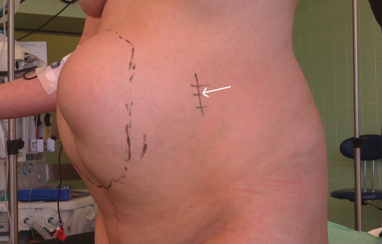 UZ navigovaná miniinvazivní komponent separace
Šipka – označena oblast miniincize.
Fig. 9: Ultrasound navigated miniinvasive component separation
Arrow – point of interest for miniincision.
