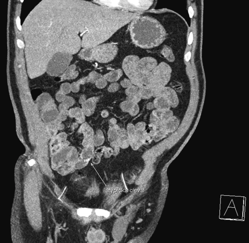 CT enterografia – snímok zachytávajúci cievnu malformáciu na terminálnom ileu (frontálny rez)
Fig. 1. CT enterography – a view depicting a vascular malformation in the terminal ileum (frontal section)