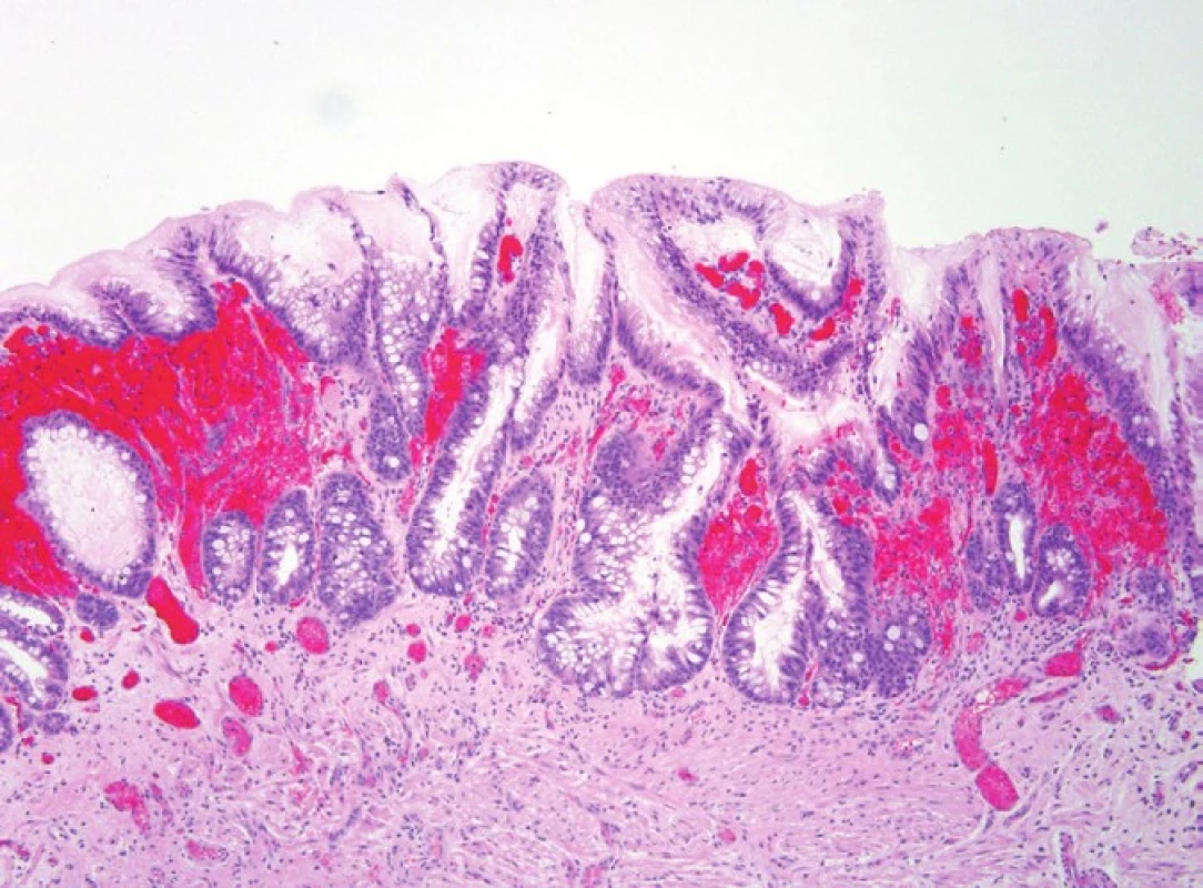 This example of nondysplastic Barrett mucosa shows features similar to those seen in serrated colorectal polyps, especially the microvesicular variant. H&amp;E (100x).