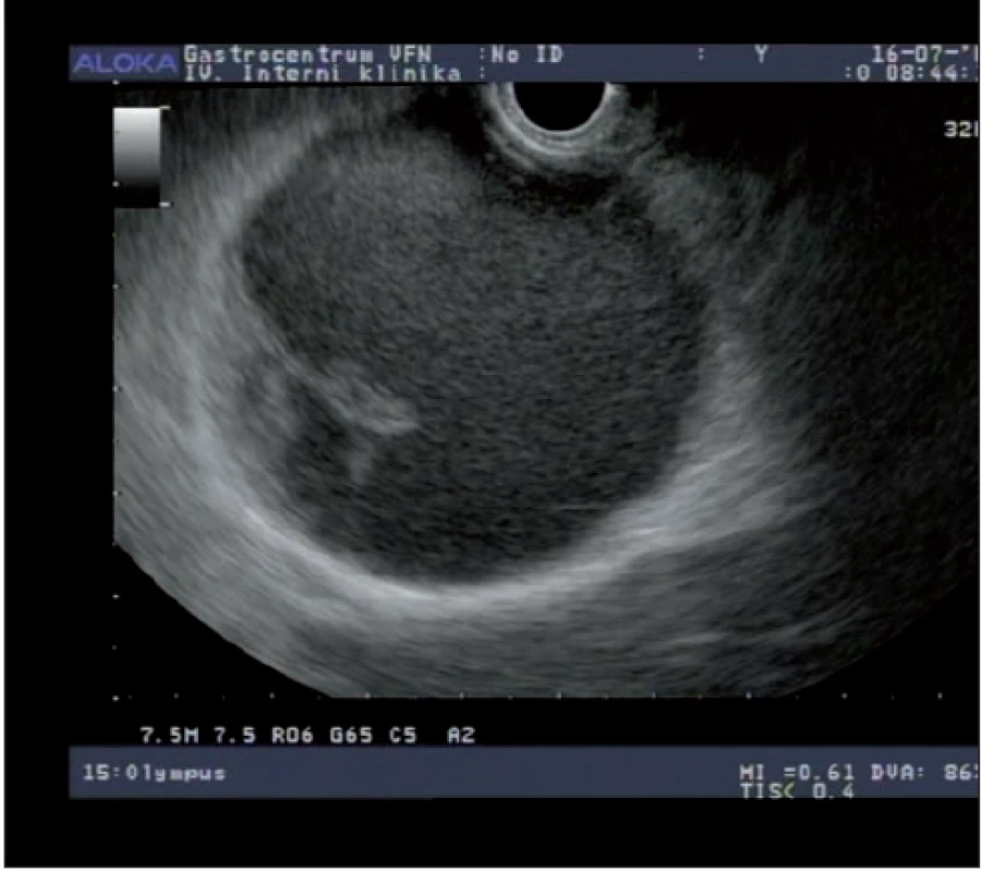Solidní pseudopapilární tumor pankreatu