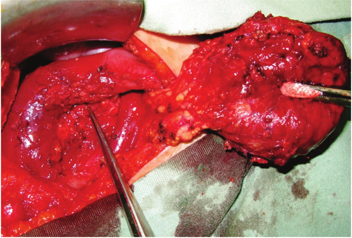 Tumor hlavy pankreatu (duodenum šetřící resekce hlavy pankreatu)
Fig. 2: Tumor of the pancreatic head (duodenum-preserving head resection of the pancreas)
