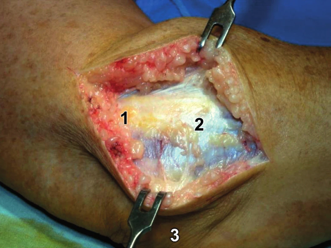 Modifikovaný Kocherův přístup – kožní řez: 1 – epicondylus lateralis humeri, 2 – fascie extenzorů, 3 – olekranon.
Fig. 7: Modified Kocher approach – skin incision: 1 – lateral epicondyle of humerus, 2 – common extensor fascia, 3 – olecranon.