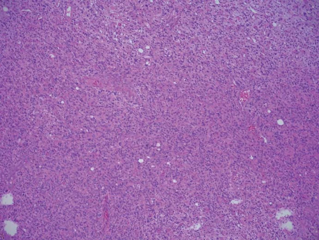 Histologický preparát barvený HE ze zóny se silnou intenzitou fluorescence.
Infiltrace nádorovými elementy zaujímá 100 % materiálu.
Fig. 1. A histological slide stained with HE from the high fluorescence intensity zone.