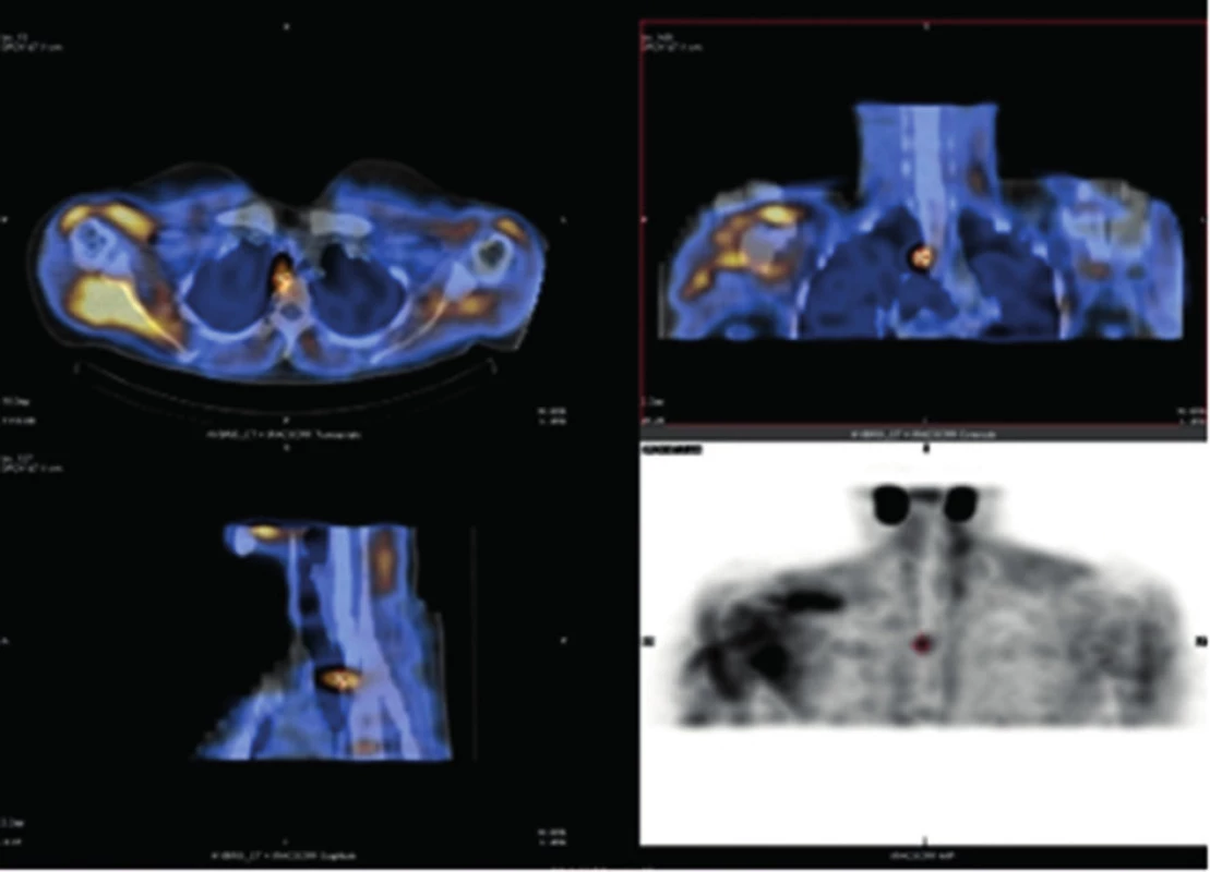 SPECT/CT − kazuistika 3
Fig. 3: SPECT/CT − case report 3