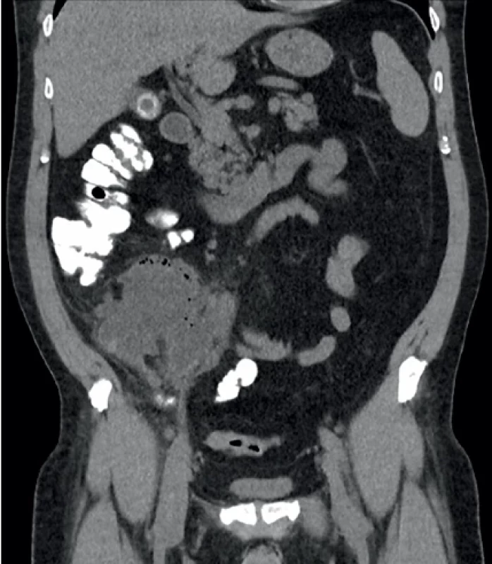 Periapendikulární infiltrát s abscesem na CT.  CT scan of an abscess with an infiltrate.