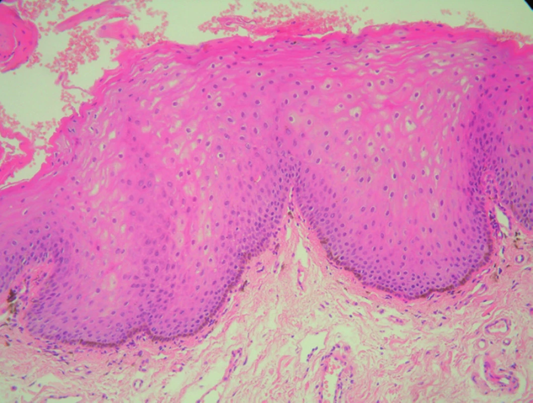 Histologický obraz orálnejmelanotickejmakuly (HE, 200x).
