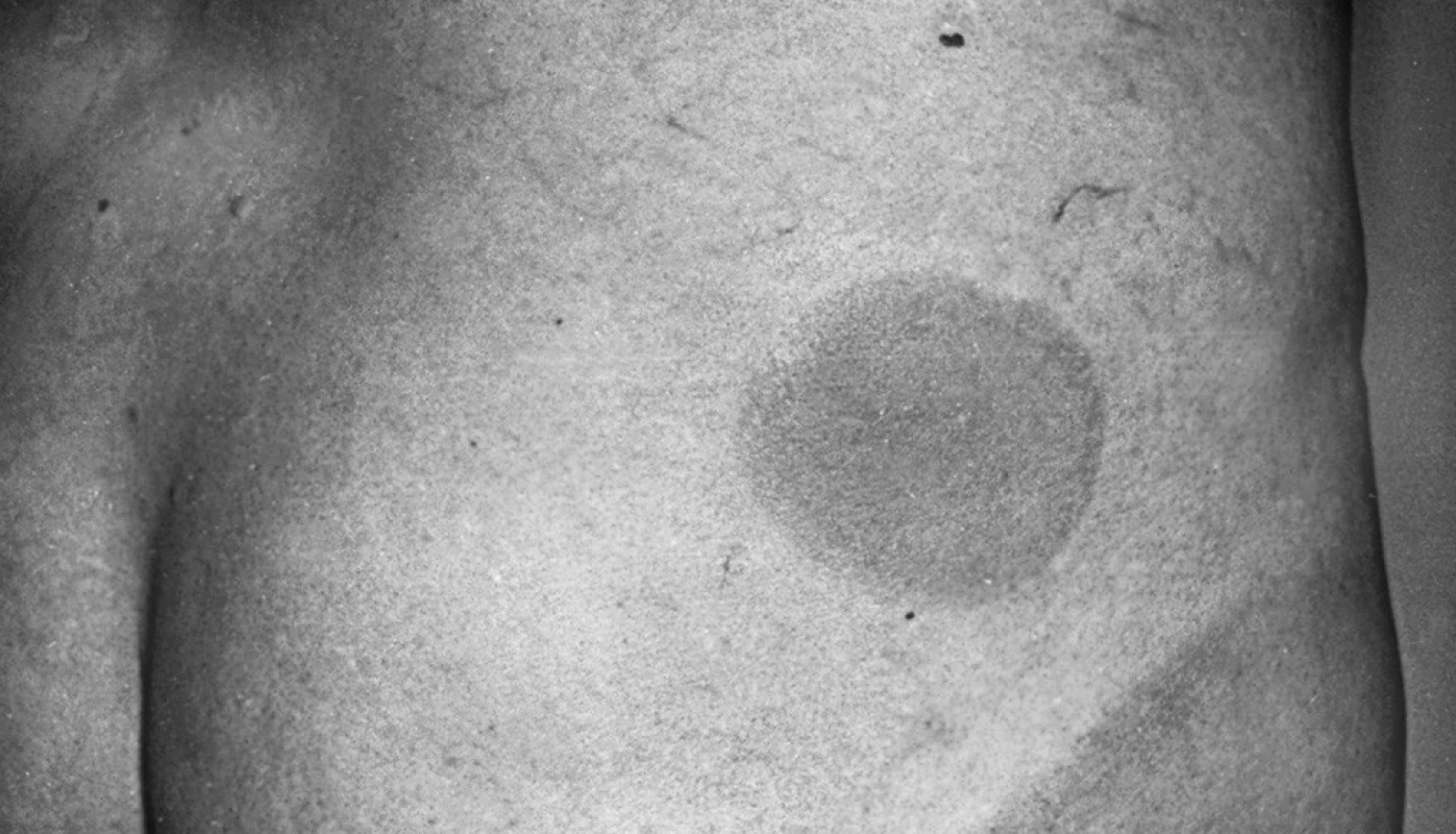 Recurrent erythema migrans on the buttock area.
The first episode developed 10 days after visiting an endemic area, and was followed by other 4 EM episodes, with EM observed twice at the same site on the buttock.