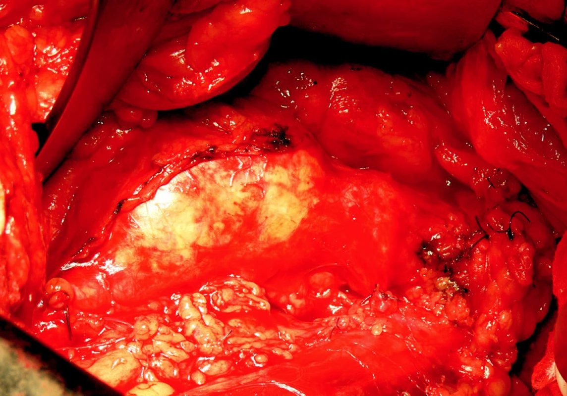 4. Resekce AAA s A-A náhradou z extraperitoneálního přístupu
Fig. 4. Resection of the AAA with A-A implantation performed using the extraperitoneal approach