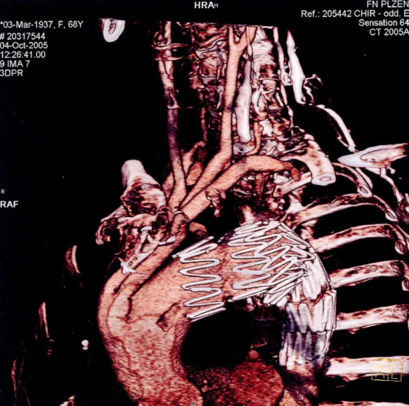 3D CTAG image of the condition at the post-operation follow up after 3 months
Obr. 5. 3D CTAG obraz stavu při kontrole 3 měsíce po operaci