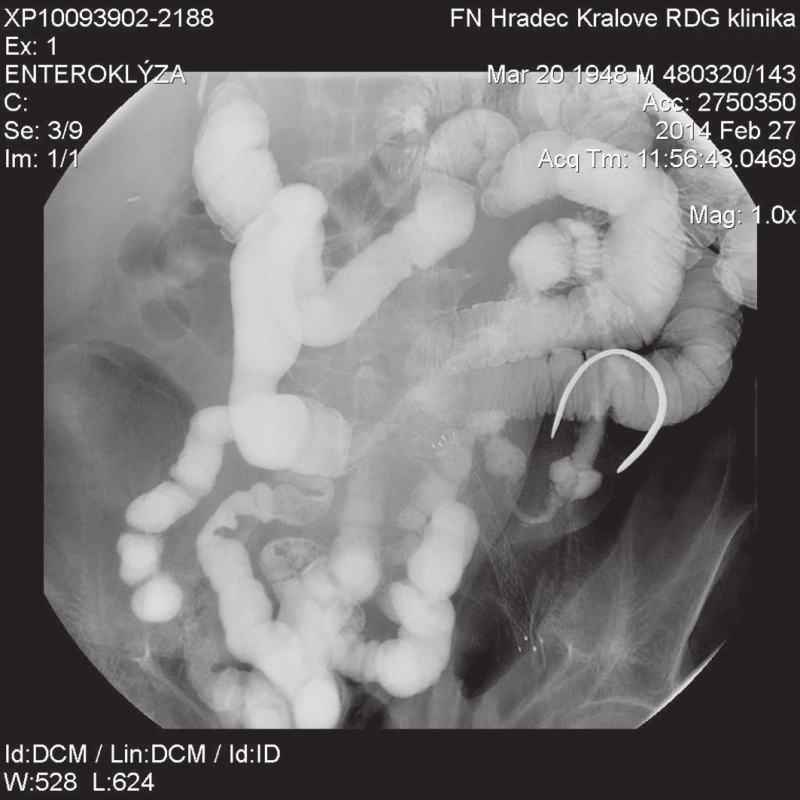 Enterografie
Stenóza na přechodu jejuna a ilea v délce 15−20 cm se zúženým lumen na 5 mm.
Fig. 2: Enterography
Stenosis of the transition from the jejunum to the ileum of 15-20 cm in length with a lumen narrowed to 5 mm.
