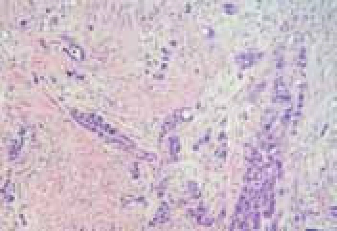 Histologický nález z biopsií odebraných v rektu ve vzdálenosti 10 cm od análního okraje (z archivu prim. MUDr. I. Vítkové z Hlavova patologicko-anatomického ústavu v Praze).