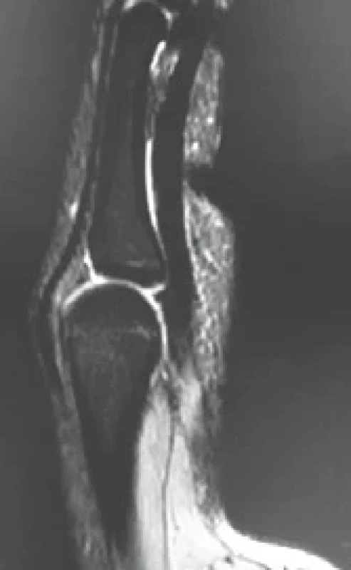 Postoperative MRI: reposition of the basis of the proximal phalanx.