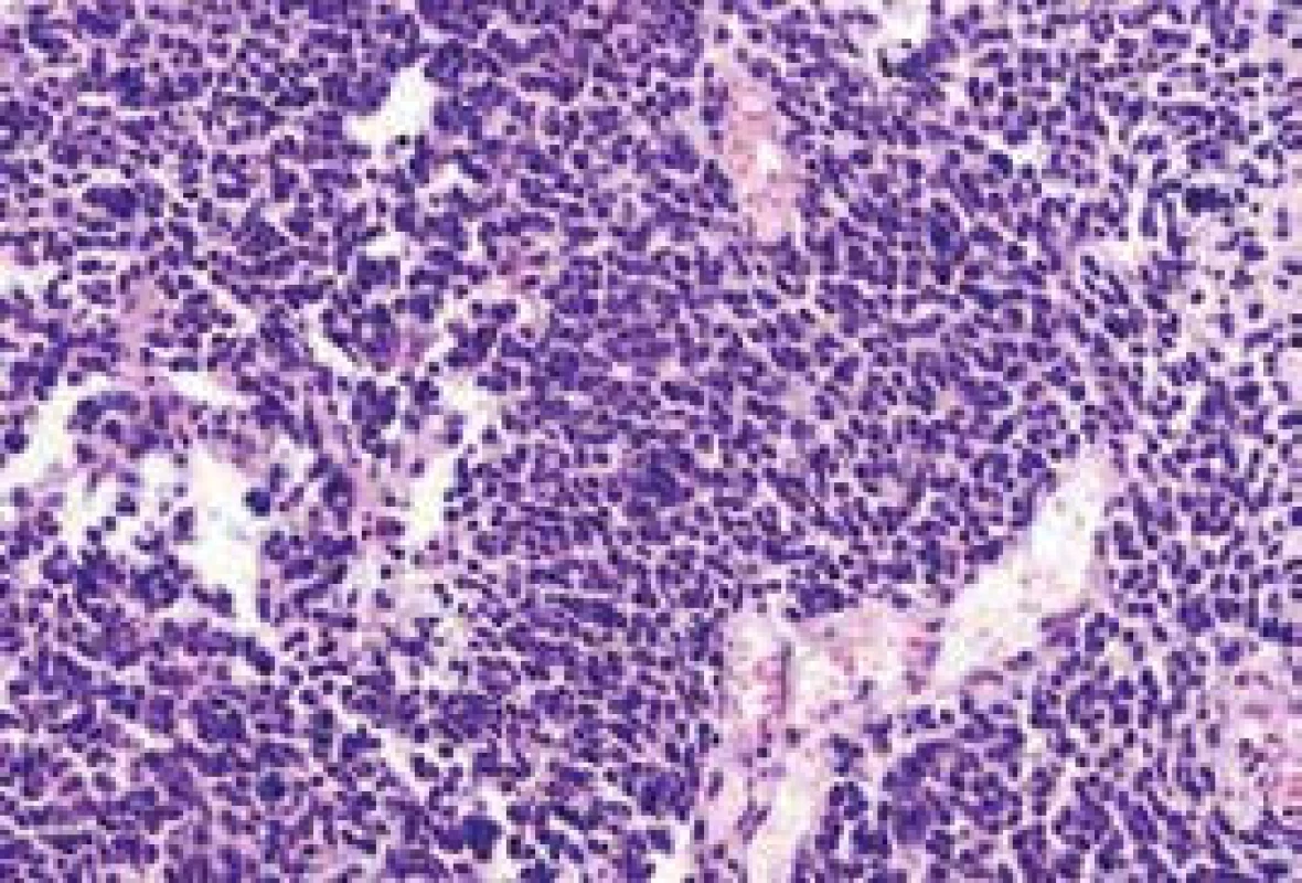SCLC – základní barvení hematoxylin-eozin
