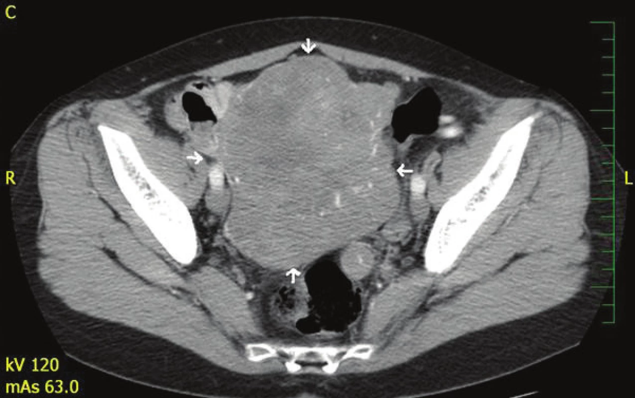 CT břicha s nálezem expanze v dutině břišní a malé pánvi
Fig. 2: CT of the abdomen with a finding of expansion in the abdominal cavity and small pelvis