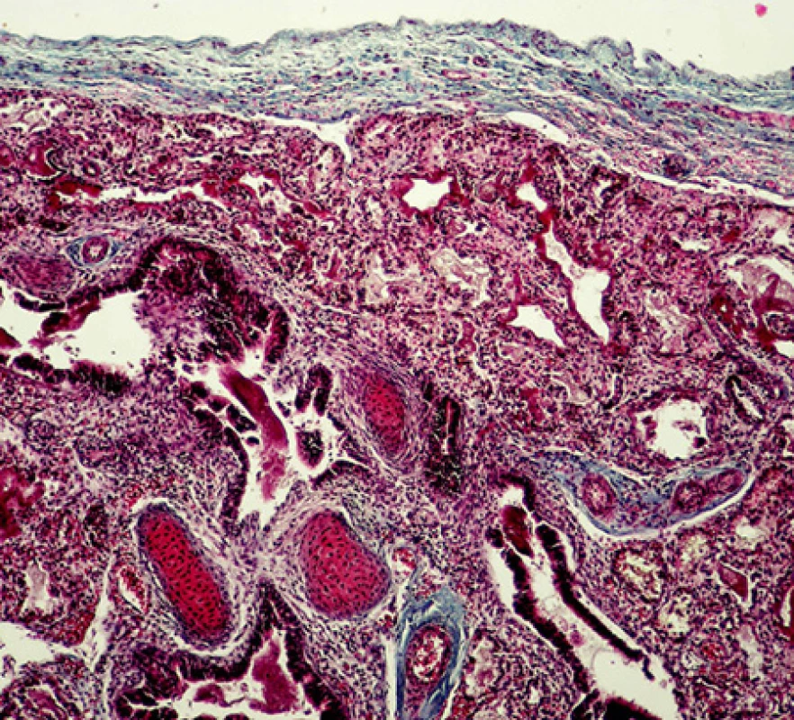 Histologický průkaz závažné hypoplazie plic: redukce počtu bronchů a bronchiolů, snížený radial count (terminální bronchioly se nacházejí těsně pod pleurou a nejsou odděleny řadou 4-5 alveolů), zmnožení mezenchymálních tkání (chrupavka, vazivo) kolem bronchiolů, intersticiální zmnoženi vaziva (barvení na vazivo - modrý trichrom, publikováno se souhlasem Ústavu patologie VFN a 1. LF UK)
