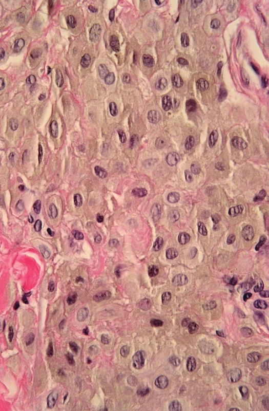 Hyperpigmentovaná léze. A. Asymetrická intradermální, hluboko sahající léze, B. detail – cytologické vlastnosti lze stěží posoudit pro překrytí jader melaninem, C. po vybělení melaninu jsou patrné epiteloidní melanocyty s hypochromními
monomorfními jádry. Při absenci mitóz i zánětlivé reakce a pozitivitě buněk na S100 nález svědčí pro epiteloidní modrý névus (HE, A 40x, B 400x, C 400x).