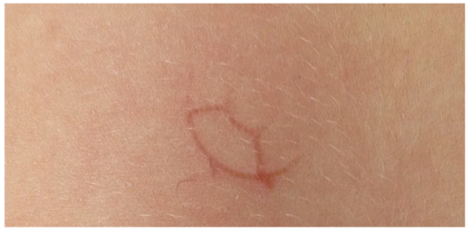 Projev kožní infekce u naší pacientky.
Fig. 1. Manifestation of the skin infection at our patient.