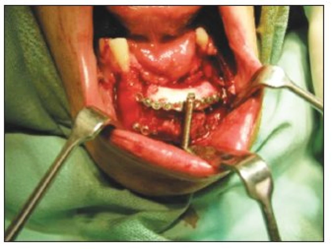 Distractor insertion