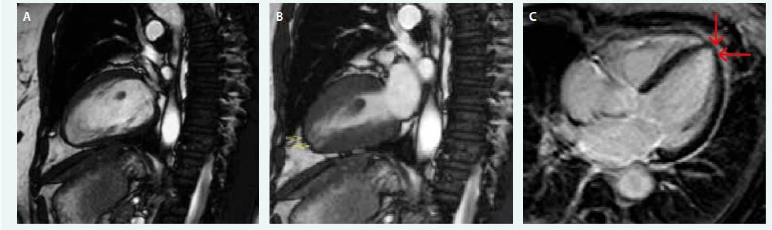 Nález MRI pacientky s TCM