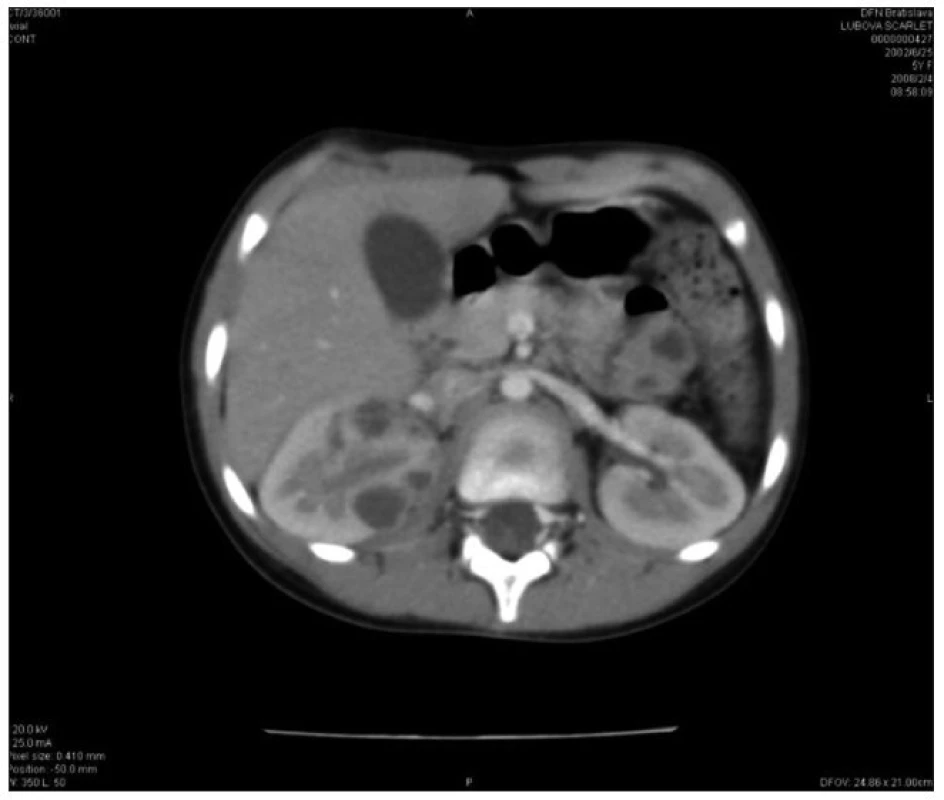 CT vyšetrenie: početné kortikálne a subkapsulárne oválne ložiská obličiek bilaterálne so zväčšenou pravou obličkou.
Fig. 3. CT imaging: numerous bilateral cortical and subcapsular oval foci with enlarged right kidney.