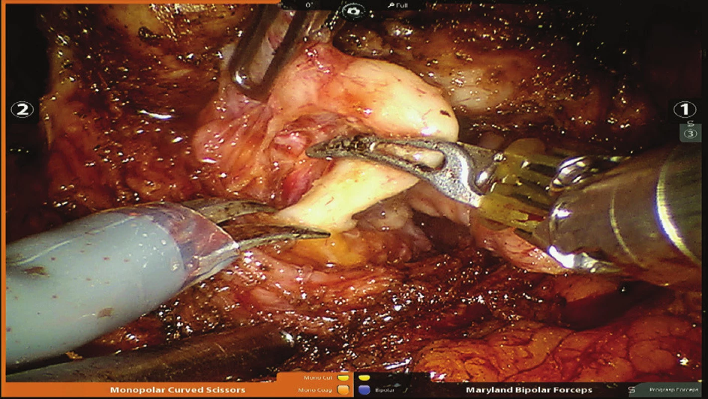 Koagulace levého chámovodu
Fig. 4: Coagulation of the left vas deferens