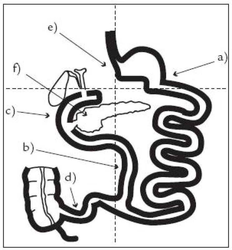 Metabolický účinek biliopankreatické diverze na různých úrovních zažívacího traktu (vysvětlení v textu).