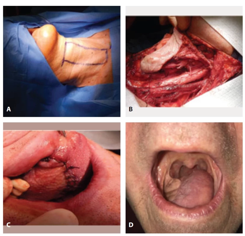 Infrahyoid myocutaneous fl ap in reconstruction of the hemitongue.