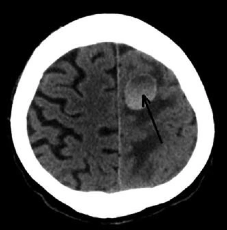 CT mozku – metastatické postižení CNS (šipka).
Fig. 12. Brain CT scan – brain metastatic leasion.
