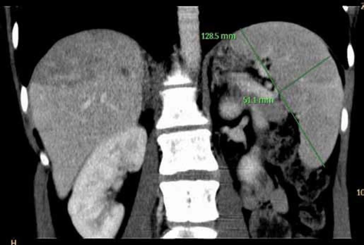 Trojfázové CT jater: venózní fáze – splenomegalie.
Fig. 2. Contrast CT of liver: venous phase – splenomegaly.