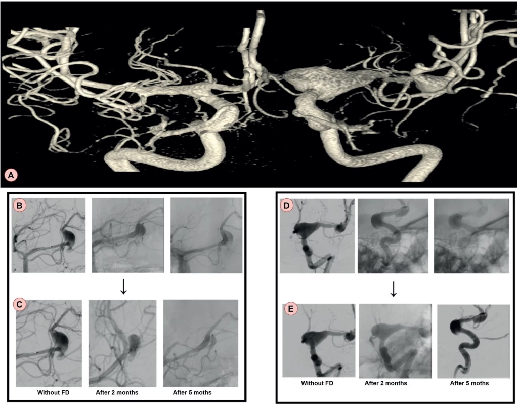 Intracranial aneurysms in a patient from the first case report.