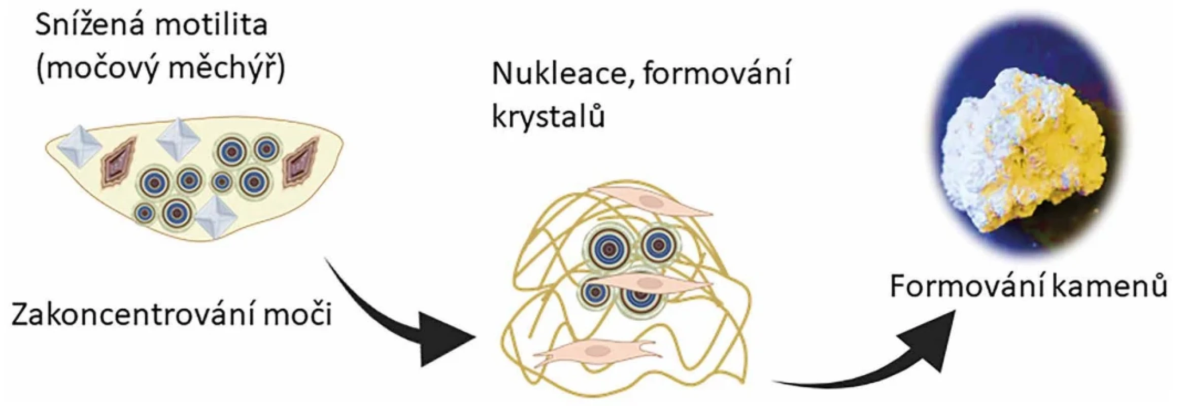 Pravděpodobné schéma tvorby krystalů a kamenů v močovém měchýři. Dochází ke snížení motility močového měchýře a  tím i  snížení odvodu moči a  její následné celkové zakoncentrování. Následně kolem nukleačních center probíhá krystalizace a formování vlastních kamenů.