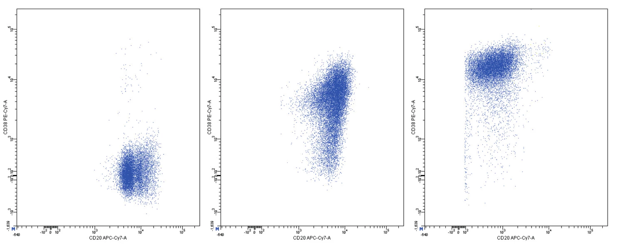 Variabilní exprese znaků CD20 a CD38, dvouparametrové dot plot diagramy, CD20 na vodorovné a CD38 na svislé ose, logaritmická škála exprese na obou osách