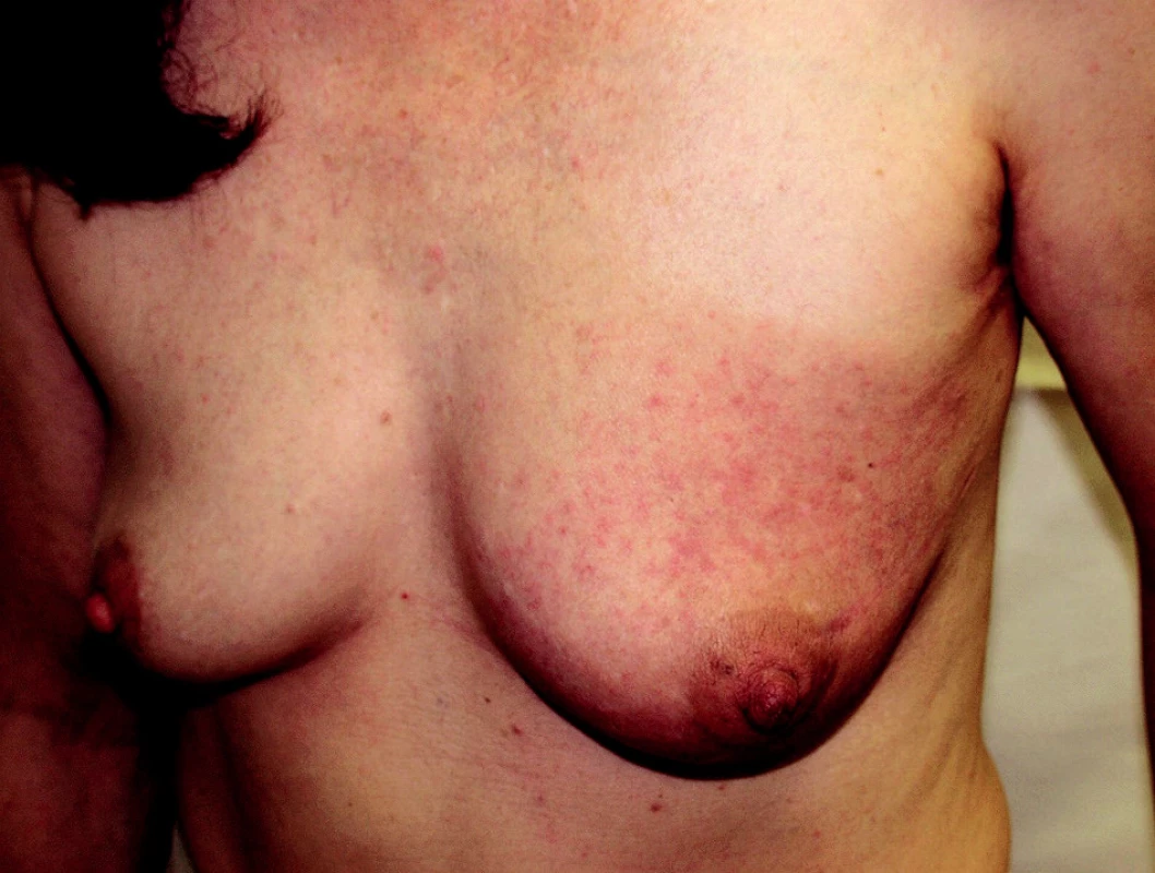 Carcinoma erysipelatoides