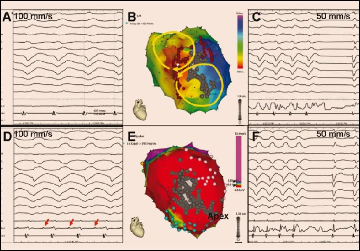 <b>Aktivační elektroanatomická mapa (B) při incesantně běžící poinfarktové KT (A).</b> Žluté šipky na obrázku B naznačují šíření elektrické aktivace dvěma aktivačními frontami (tzv. aktivace ve tvaru číslice 8), přičemž kritická oblast pomalého vedení je lokalizována v oblasti rozsáhlé anteroseptální poinfarktové jizvy, což je zjevné z voltážové mapy (E) (pohled na levou komoru je na obou obrázcích přibližně v levé šikmé projekci). V aktivační mapě (A) označuje červená barva aktivaci časnou a fialová barva aktivaci pozdní. Ve voltážové mapě kóduje červená barva oblast s nízkou voltáží < 0,5 mV reprezentující víceméně jizvu, fialová barva značí oblast s dobrou voltáží > 1,5 mV generovanou zdravým myokardem a zbytek barevného spektra kóduje okraje jizvy s defektním přežívajícím myokardem. V obou mapách je šedou barvou označen region zcela bez elektrických potenciálů, reprezentující kompaktní jizvu. Mapovaná KT (A) měla kritickou oblast pomalého vedení společnou pro oba reentry okruhy v místě, kde se setkává časná a pozdní aktivace. Při ablaci v tomto místě se tachykardie ukončila (C), protože však ablační katetr (ABL, ABL d) nesnímal prakticky žádný elektrický potenciál, je pravděpodobné, že arytmogenní substrát byl uložen spíše epikardiálně. Druhá indukovaná tachykardie (D) hůře hemodynamicky tolerovaná byla ukončena ablací (F) níže a blíže hrotu v místě, kde ablační katetr snímal middiastolické potenciály (červené šipky na obrázku D). Následně byla strategie přímého mapování doplněna o substrátovou ablaci zaměřenou na eliminaci pozdních potenciálů v nejbližším okolí (místa aplikace RF energie jsou označena hnědými body na obrázku B). Výsledkem výkonu byla nevyvolatelnost jakékoli komorové tachyarytmie.