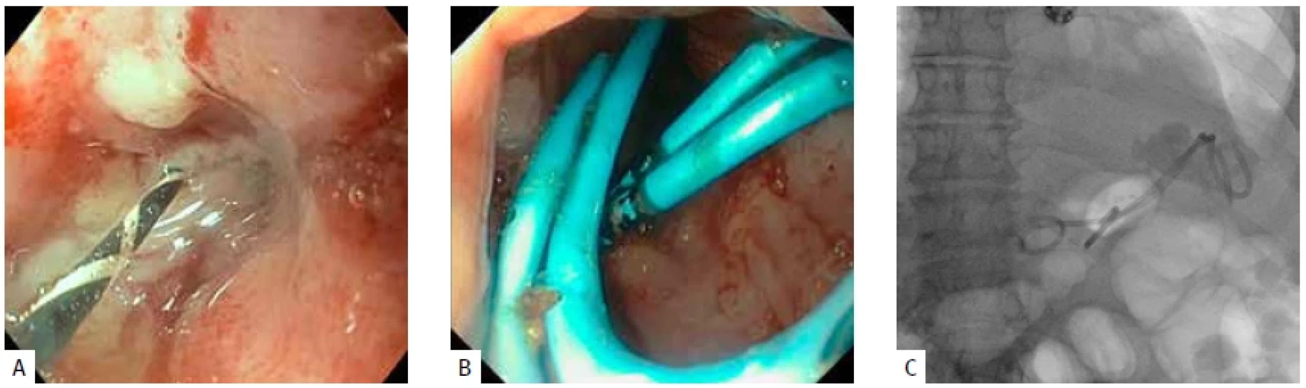 A) Fistula v horním okraji staplerové sutury po sleeve resekci žaludku se zavedeným vodičem. B) Dva plastikové stenty typu double pig-tail – endoskopický obraz. C) RTG obraz – drenáž subfrenické kolekce cestou vnitřního ústí fistuly.