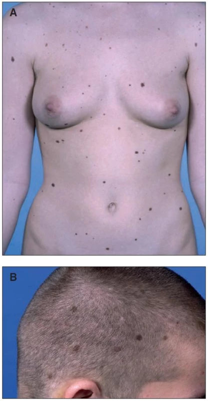 Klinicky atypické (dysplastické) névy u pacientky (A) se sporadickým syndromem dysplastických névů a (B) u pacienta s familiárním syndromem dysplastických névů a mutací genu <em>CDKN2A</em>
Familiární a sporadický syndrom není možné klinicky rozlišit.