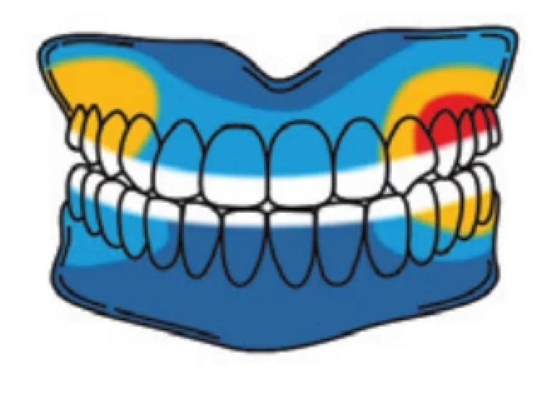 Nejčastější lokalizace bolesti u perzistující idiopatické dentoalveolární bolesti, ilustrativní schéma podle údajů Miura et al. [28] (komentář v textu).