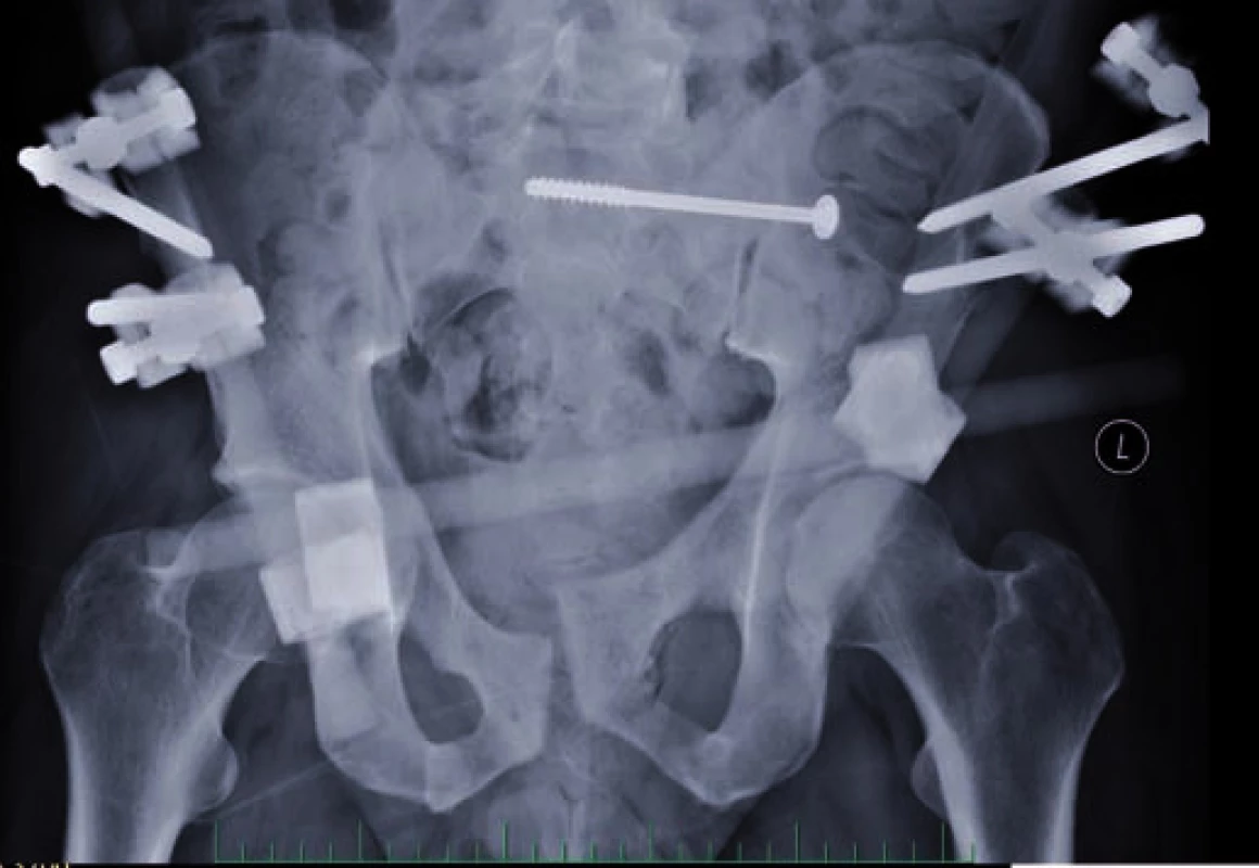 Po ošetření zlomeniny pánve zevní fixací v kombinaci s miniinvazivní osteosyntézou kanylovaným šroubem