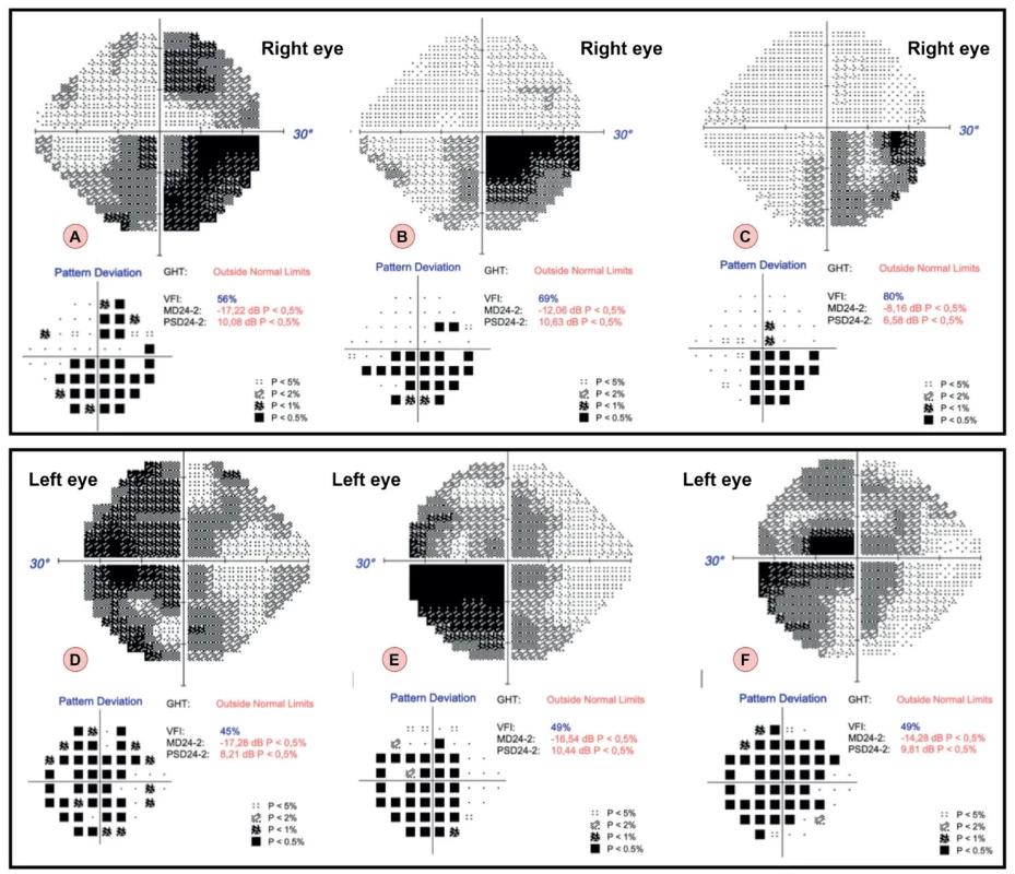 Results of the visual field examination using the 24-2 test strategy in a patient from the first case report in time.