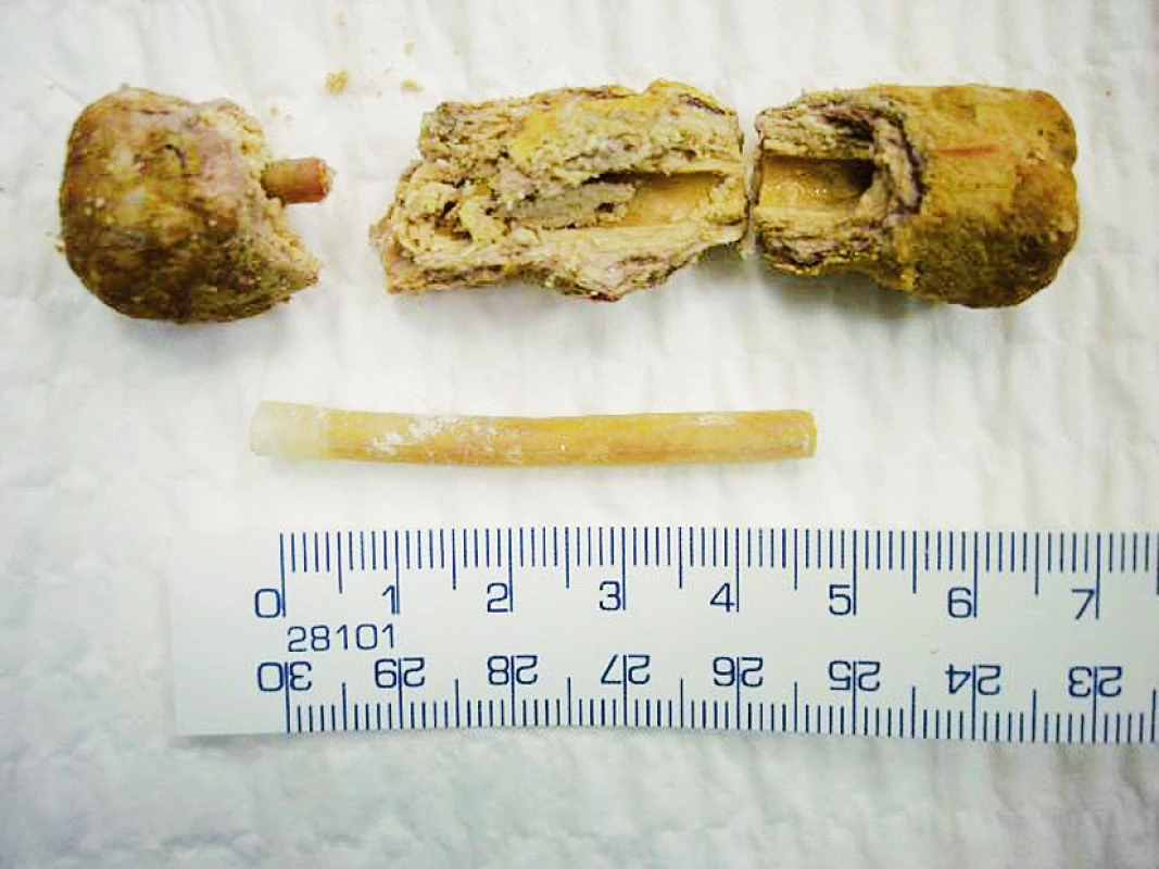 A – CT břicha (koronární řez, po aplikaci k. l., arteriální fáze) cizí těleso v měchýři, rozsáhlý absces levého retroperitonea; B – inkrustovaná plastická hadička
Fig. 3. A – CT of abdomen (coronal section after application contrast fluid, arterial phase) foreign body in the bladder, large left retroperitoneal abscess; B – encrusted plastic tube