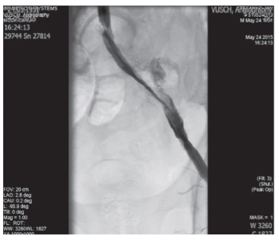 Implantácia stentgraftu do AIE l.sin.
Fig. 5: Implantation of the stentgraft in AIE l.sin.