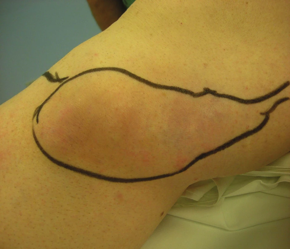 Trombozovaný konvolut varikózních žil VSM v oblasti kolena
Fig. 1: Convolution of varicose veins with thrombophlebtis of GSV in the area of the knee
