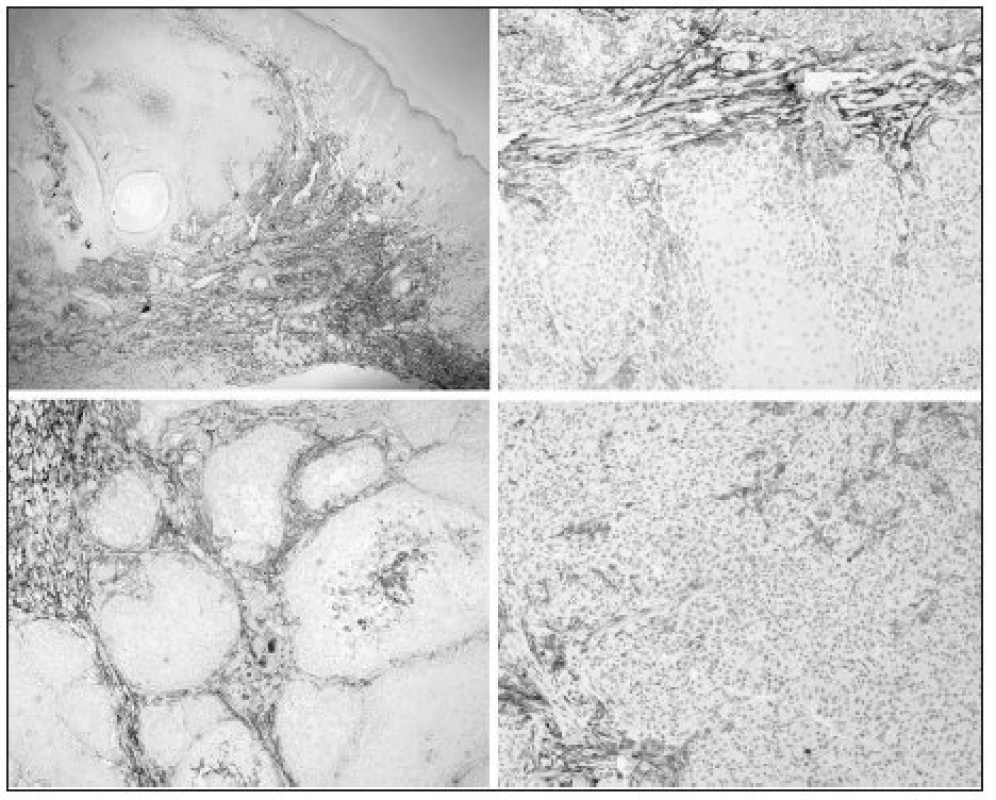 Stromal immunoexpression of CD10 in cases of SCC: KAtype (top-left); non-KA, well differentiated SCC (bottom-left); moderately differentiated SCC (top-right); and poorly differentiated SCC (bottom-right)