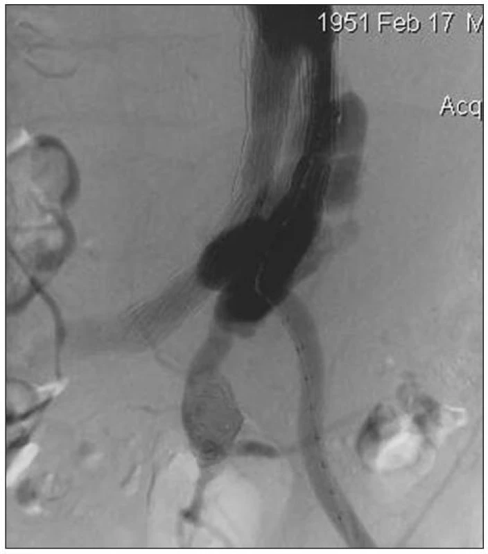 Angiografie před ošetřením Ib endoleaku (zobrazena i embolizovaná výduť levé vnitřní ilické tepny)
Fig. 2. An angiography before management of type Ib endoleak (with embolised aneurysm of left internal iliac artery)