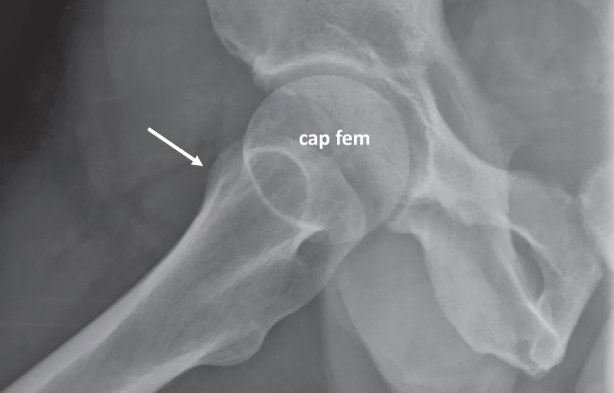 Nativní skiagram pravé kyčle, nevhodná axiální projekce kvůli sumaci  velkého trochanteru (označeno šipkou) s krčkem femuru. Fig. 9. Plain X-ray of the right hip, unsuitable axial view due to superimposition of  the greater trochanter (marked by arrow) over the femoral neck.