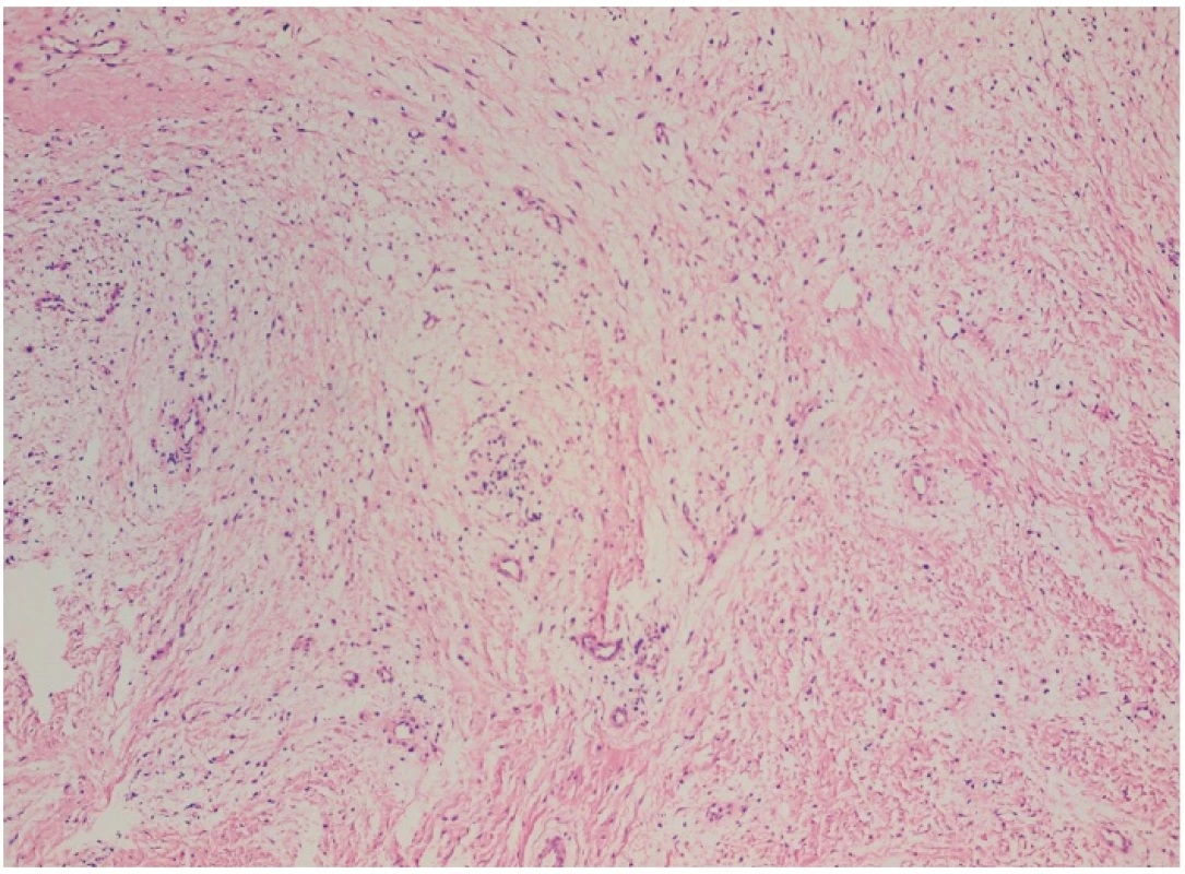 a, b Hypocelulárna stróma sliznice s variabilným zastúpením kolagénnych vlákien od denznej fibrózy (a) až s prechodom do riedkeho spojiva (b) (farbenie hematoxylín-eozín, zväčšenie 200×)